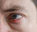 Ojo de un hombre con un orzuelo en el párpado superior, con inflamación y enrojecimiento visible