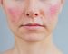 Portrait of young Caucasian woman suffering from rosacea on her face in the acute stage. Dermatological problems. Skin chronic disease