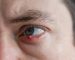 Ojo de un hombre con un orzuelo en el párpado superior, con inflamación y enrojecimiento visible