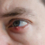 Ojo de un hombre con un orzuelo en el párpado superior, con inflamación y enrojecimiento visible